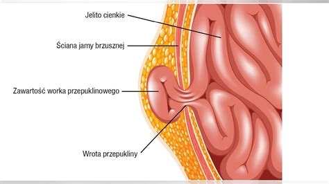 Przepukliny Brzuszne YouTube