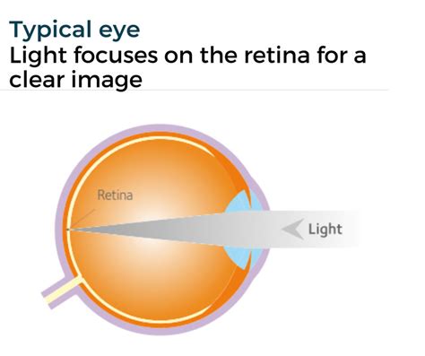 myopia management optimeyes opticians broxburn queensferry