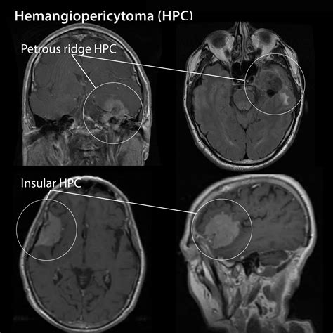 Pathology Glossary: Hemangiopericytoma | Draw It to Know It