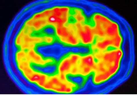 Asi Es Como Se Reparan Las Neuronas De Nuestro Cerebro