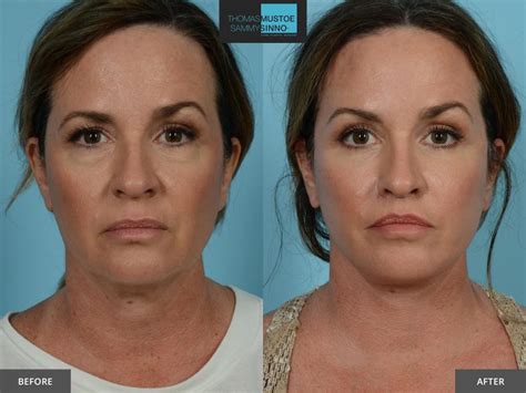 What To Do Before And After A Facelift Surgery