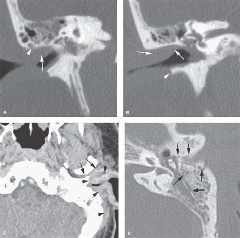 Necrotizing (“Malignant”) Otitis Externa | Radiology Key