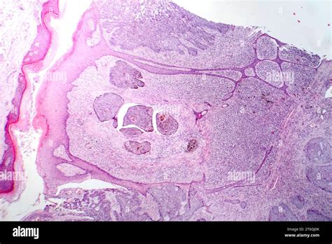 Fotomicrografía Del Carcinoma Basocelular Que Muestra Células Basales