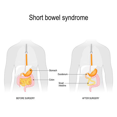 Short bowel syndrome (SBS): Small bowel ostomy diet - AGA GI Patient Center