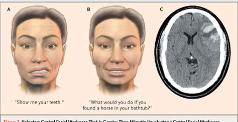 Figure 1 From Clinical Practice Bells Palsy Semantic Scholar