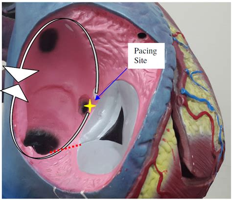 Atrial Flutter Diagnosis Management And Treatment IntechOpen