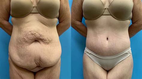 Body Lift Surgeon Chicago NW Indiana Petrungaro Plastic Surgery