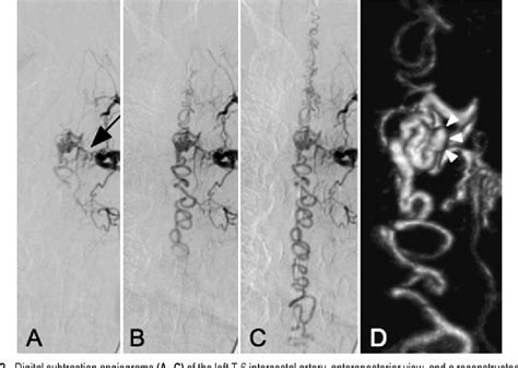 Figure 2 From Spinal Dural Arteriovenous Shunt Presenting With