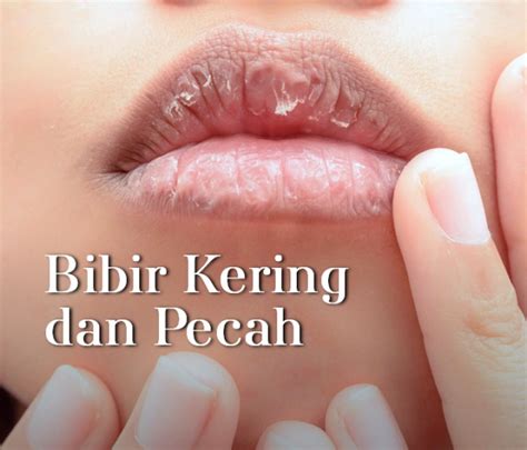 Cara Mengobati Bibir Kering Secara Alami