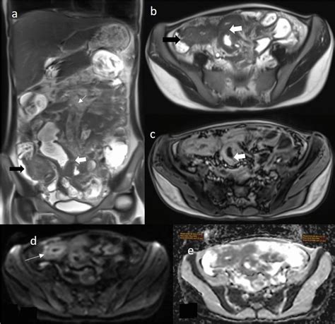 Ae T2w Coronal And Axial Image A B Show T2 Hyperintense