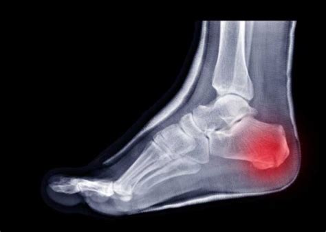 Calcaneal Fracture | Broken Heel Bone | Plantar Fasciitis | Orthopedic ...