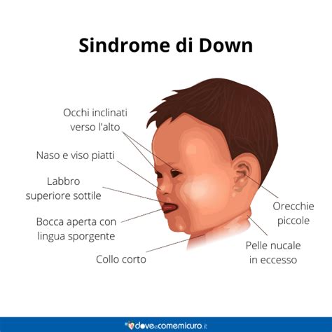 Sindrome Di Down Cause Sintomi Gravidanza Trisomia 21