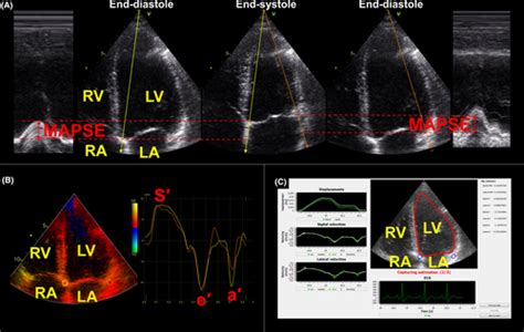 Normal Ranges For Automatic Measurements Of Tissue Doppler Indices Of