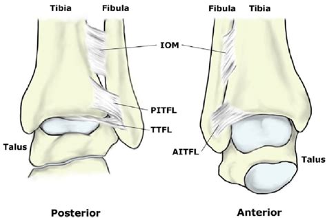 What Is A Syndesmosis Injury Body Focus Physiotherapy