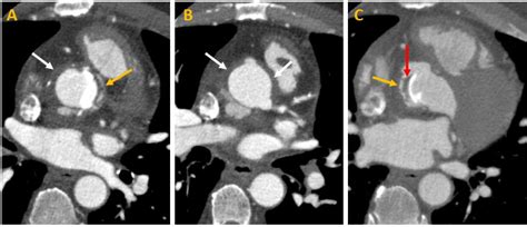 Figure 4 From Aortic Root Abscess From Enterococcus Faecalis Infective