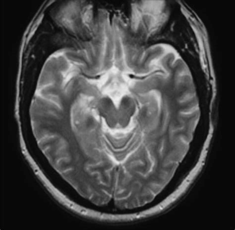 Normal Axial midbrain