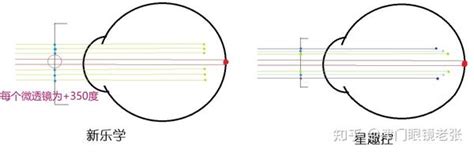 Ok镜和离焦眼镜的配适性讨论（不同年龄、度数怎么选最好？） 知乎