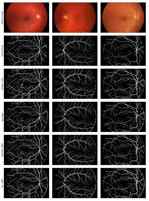 Github Arkanivasarkar Retinal Vessel Segmentation Using Variants Of