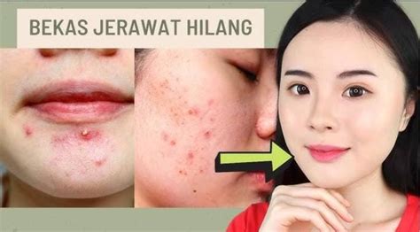 4 Cara Menghilangkan Bekas Jerawat Dengan Cepat Miliki Wajah Cerah Bebas Noda Hitam Segera