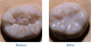 Learn About Dental Sealants From A Cosmetic Dentist In Apex