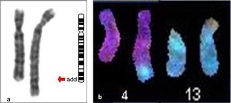 Figure 1 From Prenatal Diagnosis Of A Partial Trisomy 13q Q14 Qter Phenotype Cytogenetics