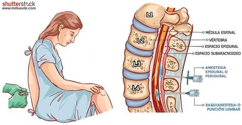 Dolor de cabeza por punción lumbar o anestesia raquídea 2022