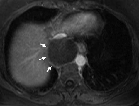 Case Thoracic Duct Cyst Radiology