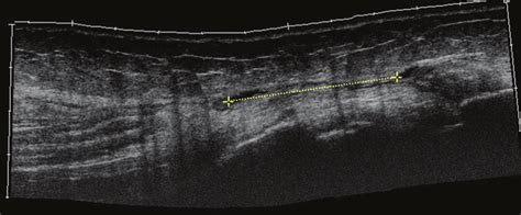 Ultrasound Scan Of The Distal Biceps Femoris Ruler Measuring Gap Left