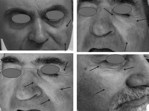 In all patients, a pallor of the cheek near the root of the nose and... | Download Scientific ...