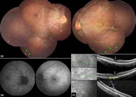 Fundus Photographs Fp Fundus Autofluorescence Faf And Oct Images