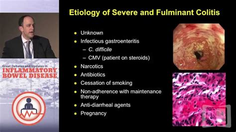 Treatment Strategies For The Acute Severe Ulcerative Colitis Patient