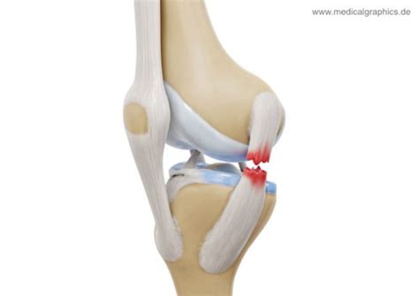 medial collateral ligament tear medial medicalgraphics