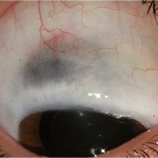 Note the malar hypoplasia and downward slanting of the palpebral ...