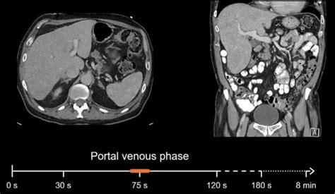 Abdominal Ct Phases • Litfl • Radiology Library