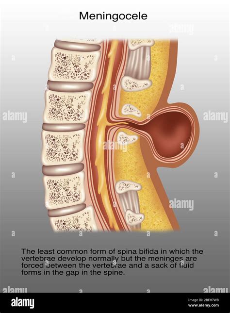 Spina bifida with meningocele hi-res stock photography and images - Alamy