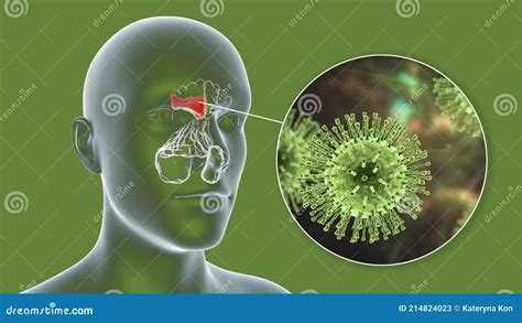 Sinusitis Viral Inflamación De Las Cavidades Paranasales Y Primer Plano