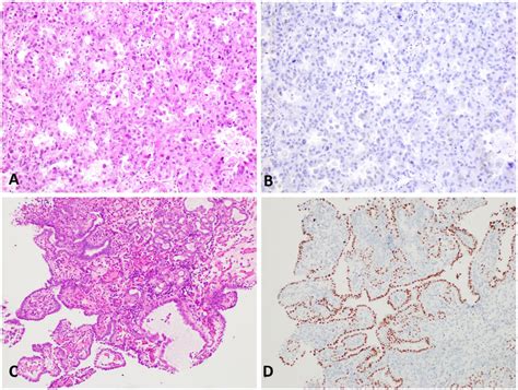 Majority Of Clear Cell Adenocarcinoma Of The Female Genital Tract Is