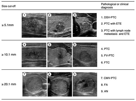 Cancers Free Full Text Diagnostic Strategies For Thyroid Nodules Based On Ultrasonographic