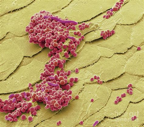 Folliculitis Bacteria Photograph By Steve Gschmeissnerscience Photo