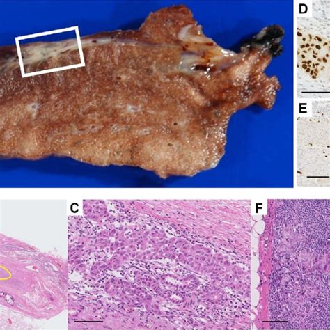 Histological Examination Of Surgical Specimens A Gross Findings Of