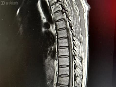 患者出现四肢麻木无力，竟是脊髓炎导致高位截瘫