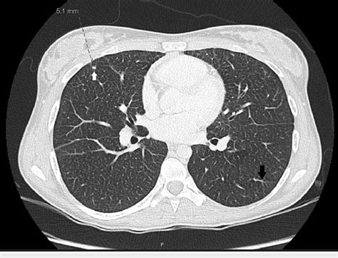 Discrete Interlobular Septal Thickening Black Arrow And Subpleural