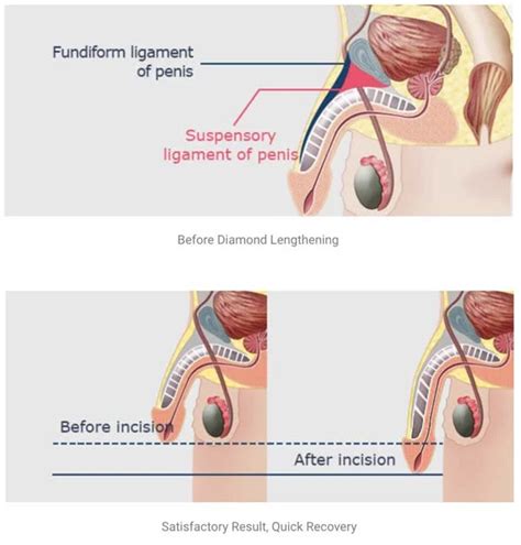 Exploring The Benefits Of Penoplasty Surgery 2024