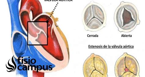 Estenosis Aórtica Qué Es Qué Estructuras Afecta Síntomas Signos