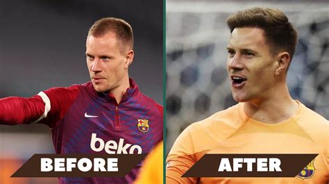 Ter Stegen S Inspiring Hair Transplant Story Sule Hair Transplant