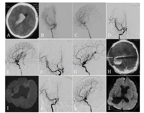 Table From Perioperative Complications Of Transvenous Embolization Of