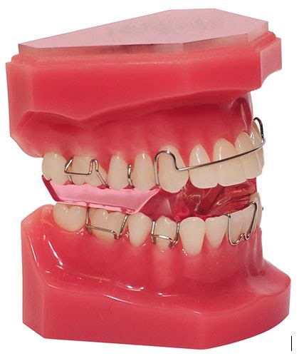 Myofunctional Appliance Focus Dentistry