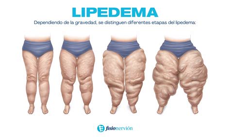 ᐅ Lipedema y Fisioterapia Qué es y cómo se trata