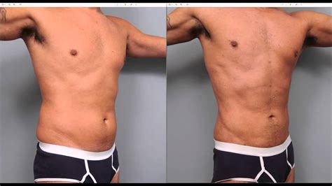 Liposuction Gone Wrong Men