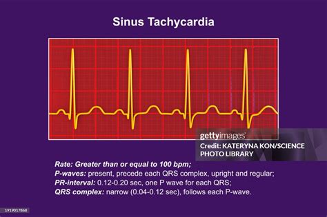 Sinus Tachycardia Heartbeat Rhythm Illustration High Res Vector Graphic Getty Images